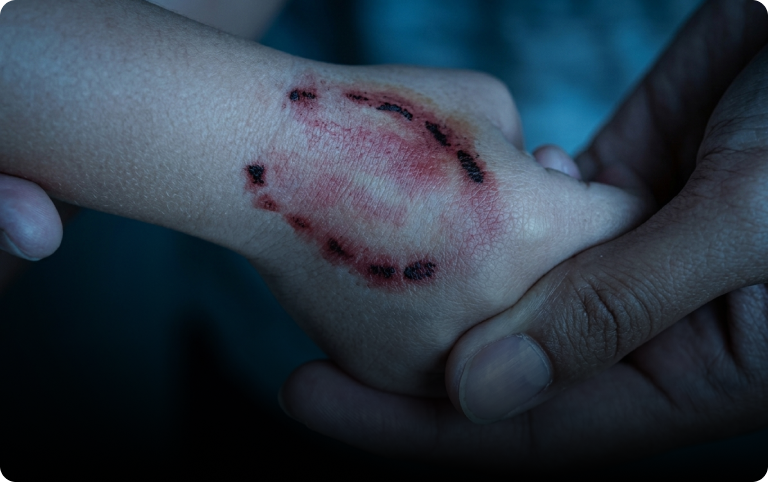 Severe Lacerations