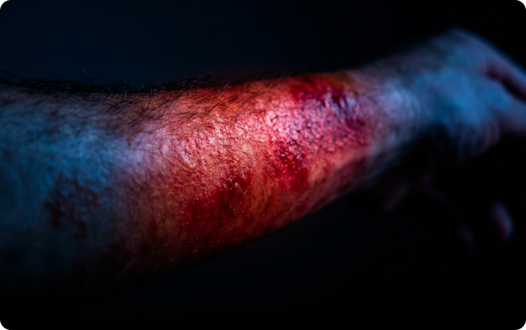 Electrical and Burns Injuries